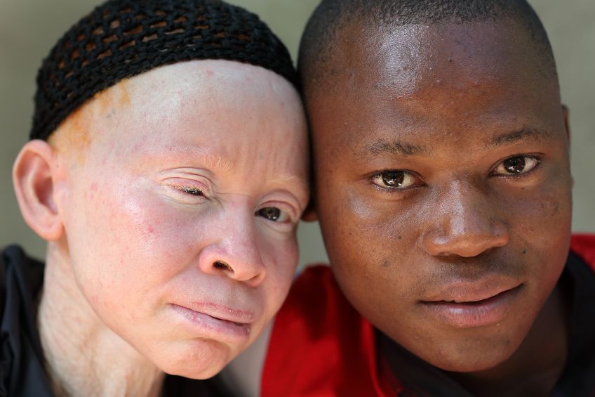 nemoc albinismus