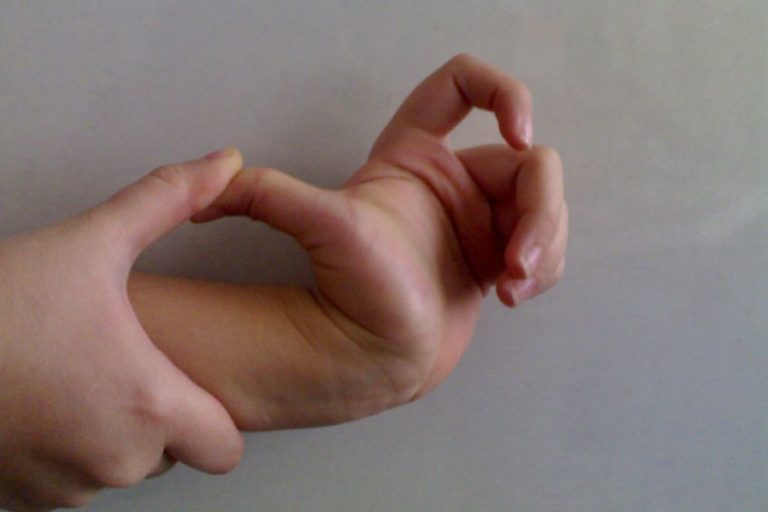 Ehler Danlos Syndrom